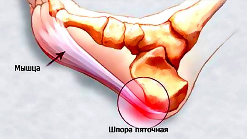 Пяточная шпора Пяточная шпора