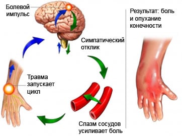 Комплексный регионарный болевой синдром Комплексный регионарный болевой синдром