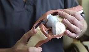 Реабилитация после пластики передней крестообразной связки