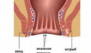 Свищ прямой кишки - симптомы и лечение у мужчин