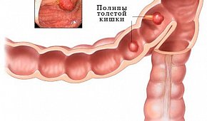 Аденоматозный полип прямой кишки - причины,  симптомы и лечение