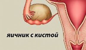 Медикаментозное лечение кисты яичника