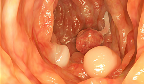 Анальные полипы - причины, симптомы и лечение