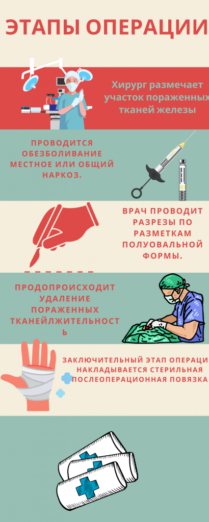удаление внутрипротоковой папилломы молочной железы
