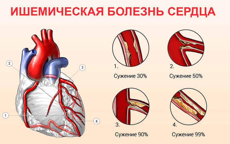 лечение ибс