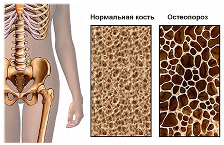 перелом шейки бедренной кости