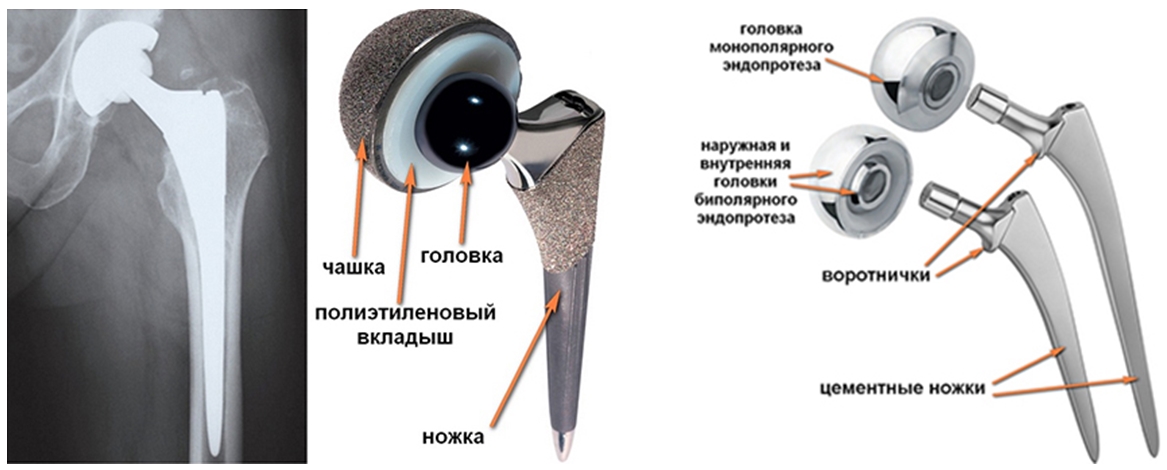 перелом шейки бедренной кости